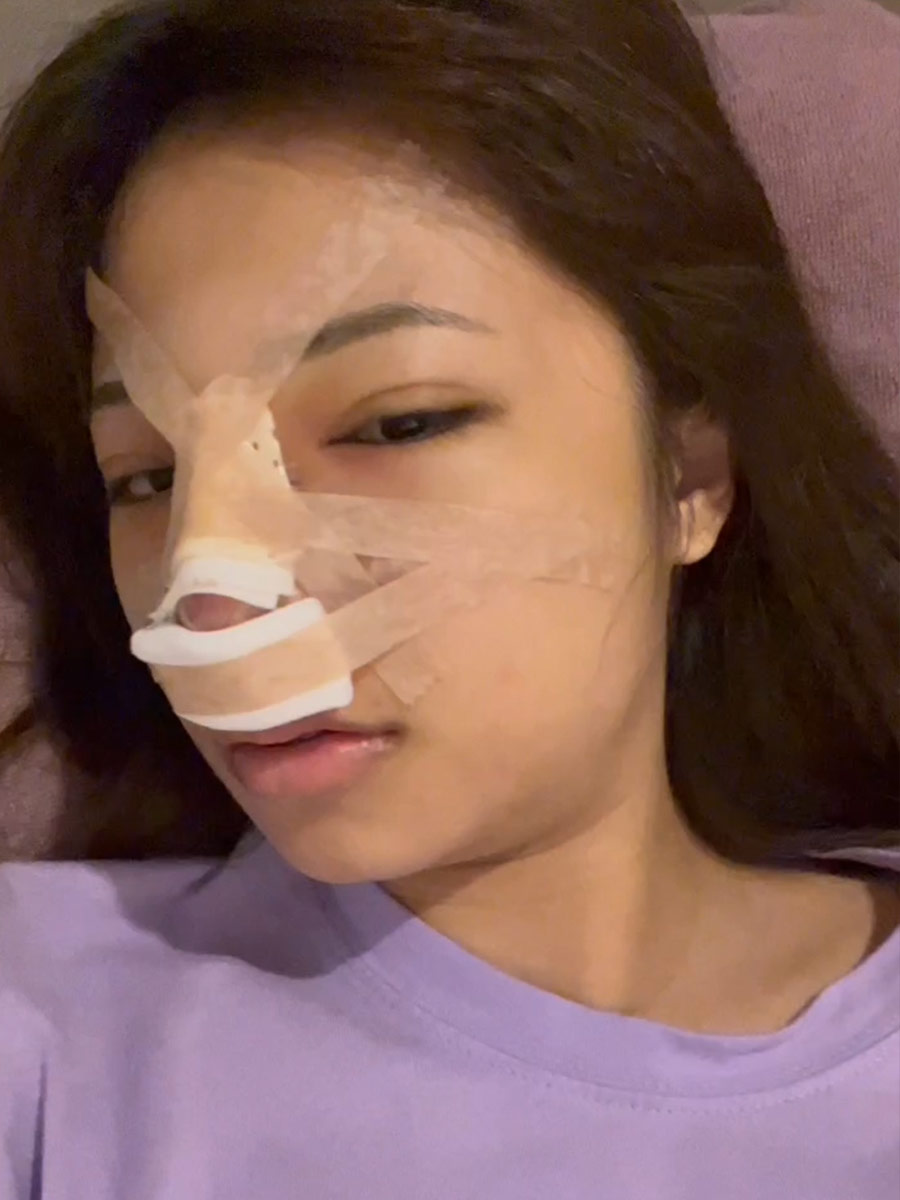 術後剛開始的腫脹