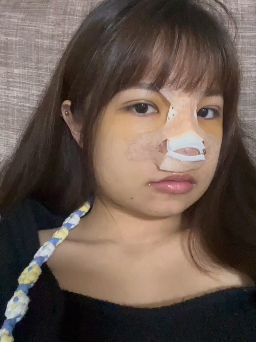 眼周跟瘀青慢慢消腫