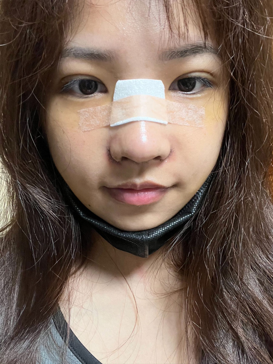 拿掉透氣膠帶舒服許多